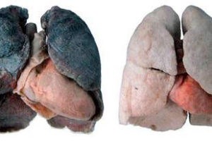 https://www.logpateth.fr/Therapie/wp-content/uploads/2016/06/comparaison-poumon-tabac-300x200.jpg